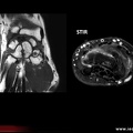 ostéonécrose post-traumatique du lunatum: IRM